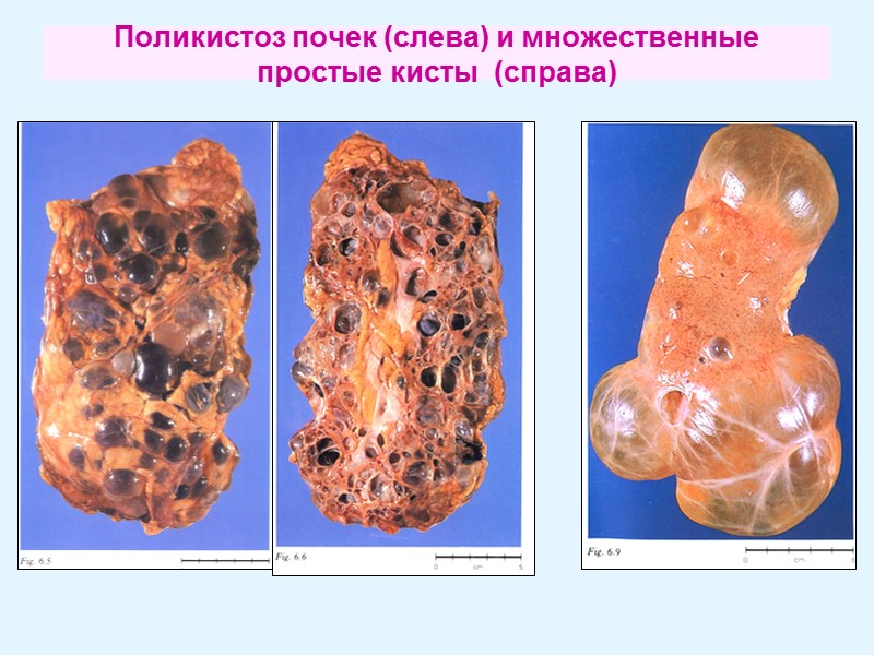 Поликистоз почек (слева) и множественные простые кисты  (справа)